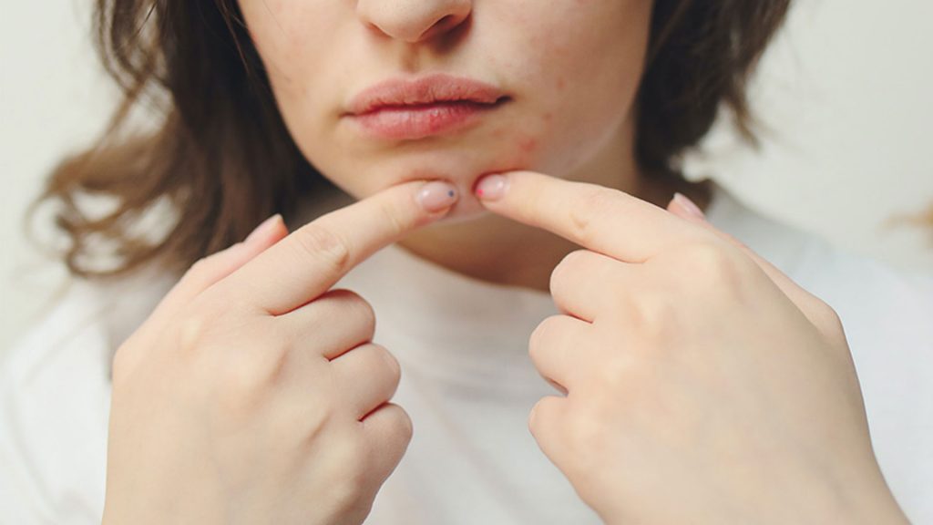 Sejak menggunakan masker menjadi kewajiban, salah satu masalah kulit wajah yang timbul ialah maskne. Begini cara mengatasi maskne.