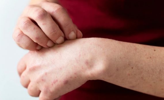 kenali psoriasis penyakit kulit kronis