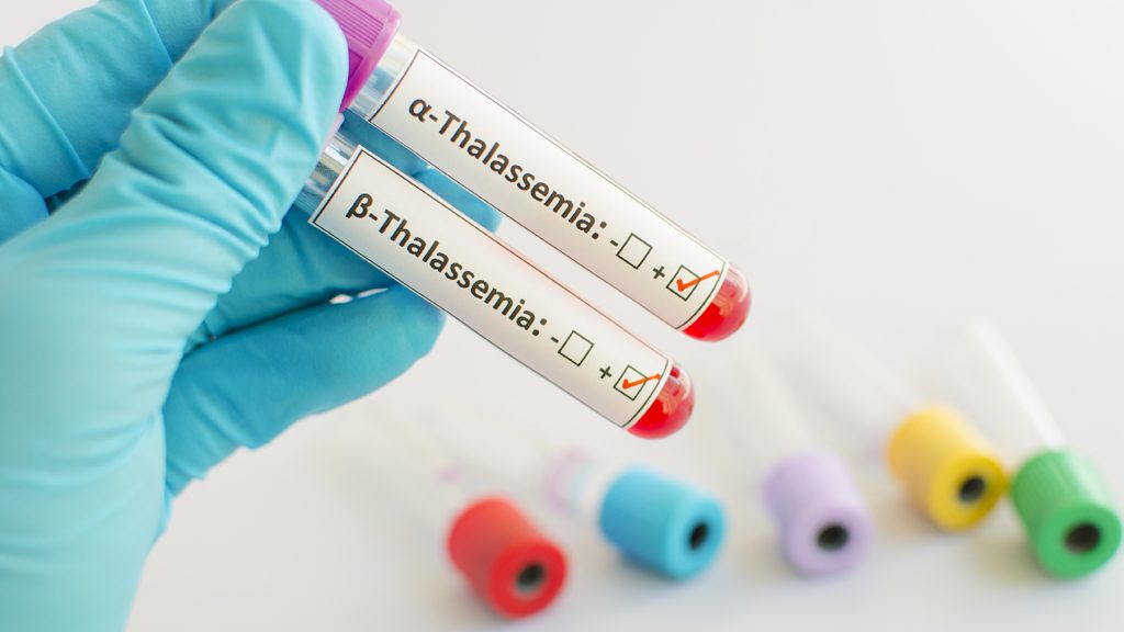 Thalassemia Pertimbangan untuk Batal Menikah Kok Bisa_3