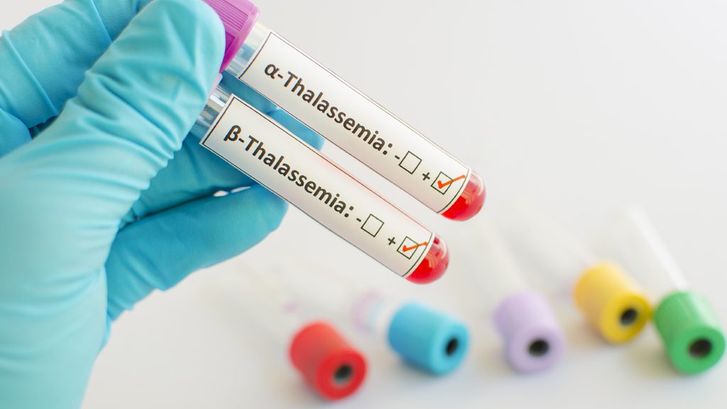 Thalassemia Pertimbangan untuk Batal Menikah Kok Bisa_3